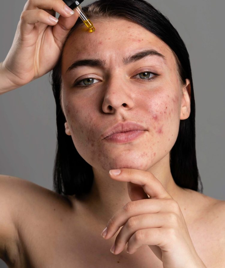 portrait-young-woman-being-confident-with-acne (1)
